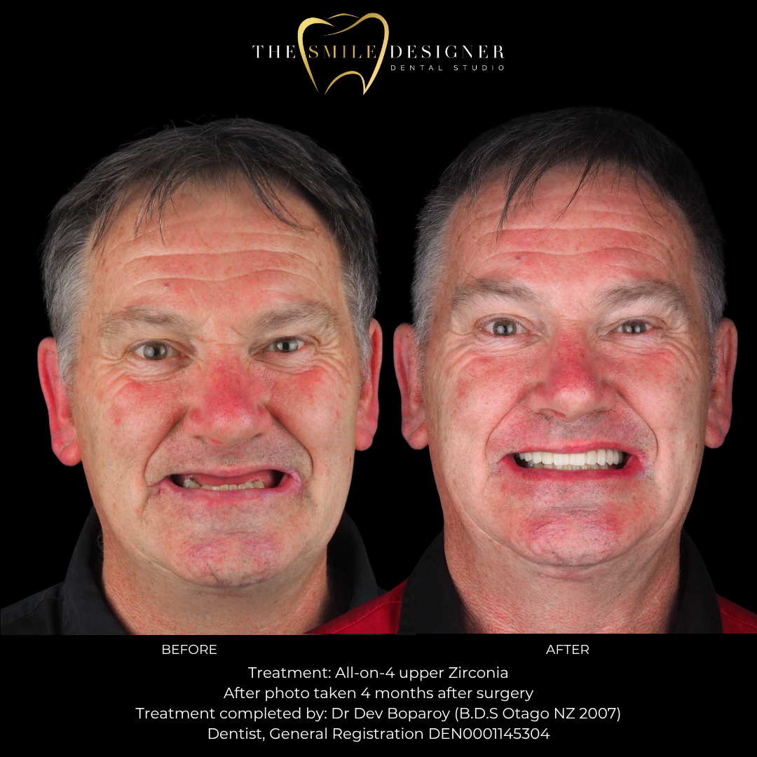 All-on-4 before and after — The Smile Designer